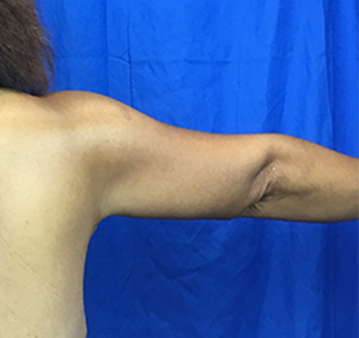 Arm Lift Before & After Patient #7209