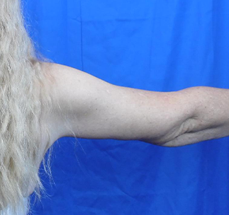 Arm Lift Before & After Patient #7217