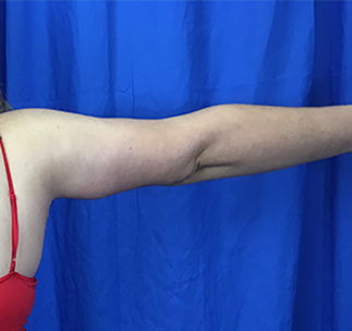 Arm Lift Before & After Patient #7225
