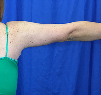 Arm Lift Before & After Patient #7191