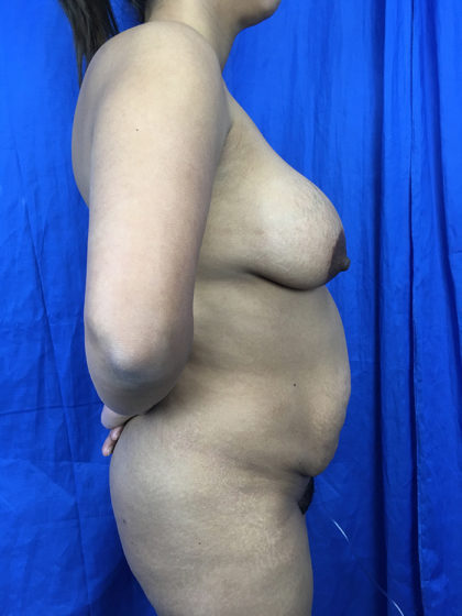 Breast Lift / Mannequin Breast Lift Before & After Patient #7777