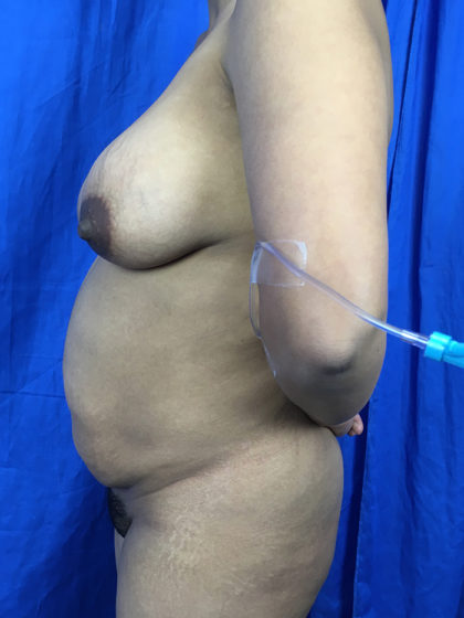 Breast Lift / Mannequin Breast Lift Before & After Patient #7777