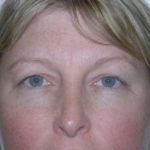 Brow Lift Before & After Patient #7822