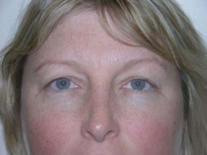 Brow Lift Before & After Patient #7822