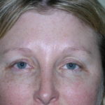 Brow Lift Before & After Patient #7822