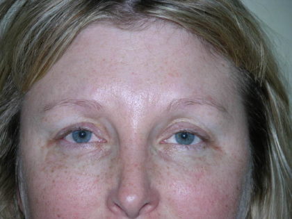 Brow Lift Before & After Patient #7822