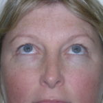 Brow Lift Before & After Patient #7822