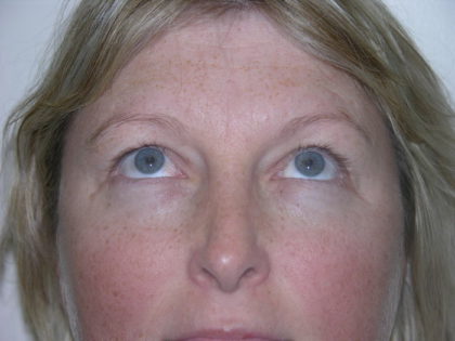 Brow Lift Before & After Patient #7822