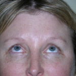 Brow Lift Before & After Patient #7822