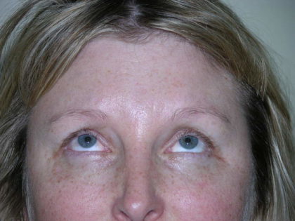 Brow Lift Before & After Patient #7822