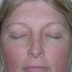 Brow Lift Before & After Patient #7822