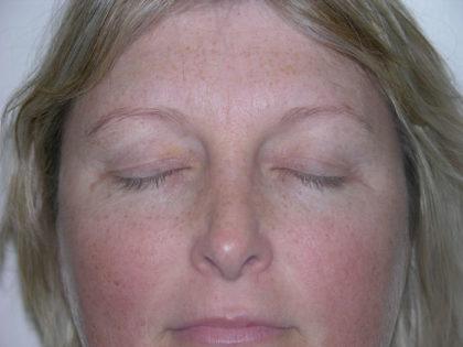 Brow Lift Before & After Patient #7822