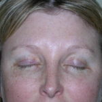 Brow Lift Before & After Patient #7822