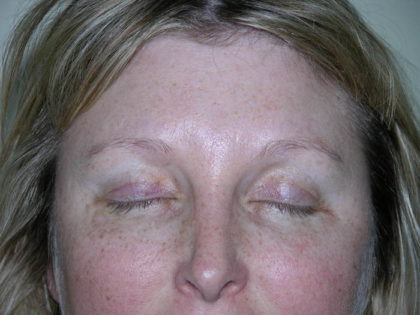 Brow Lift Before & After Patient #7822