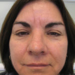 Brow Lift Before & After Patient #7829