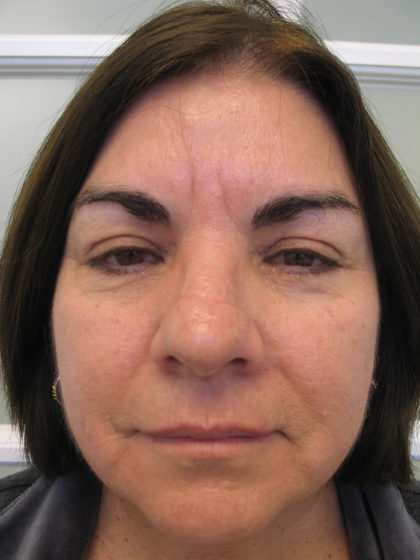 Brow Lift Before & After Patient #7829