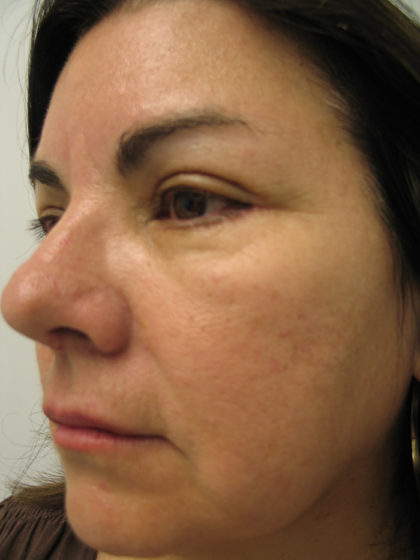 Brow Lift Before & After Patient #7829