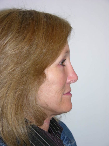 Facelift and Necklift Before & After Patient #7840