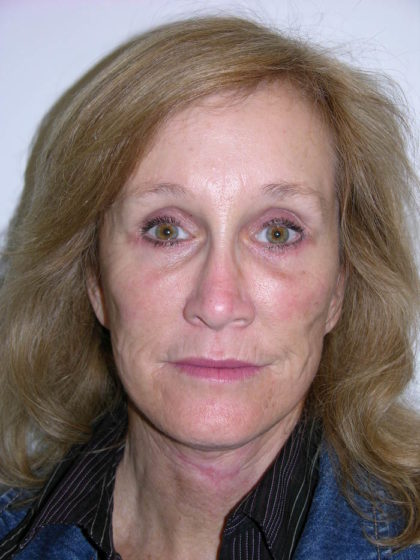 Facelift and Necklift Before & After Patient #7840