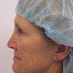 Facelift and Necklift Before & After Patient #7840