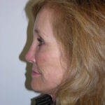 Facelift and Necklift Before & After Patient #7840