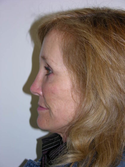 Facelift and Necklift Before & After Patient #7840