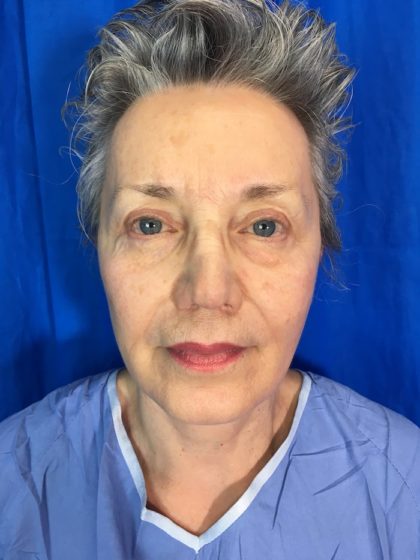 Brow Lift Before & After Patient #7851