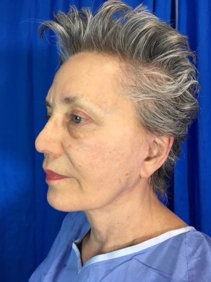 Brow Lift Before & After Patient #7851