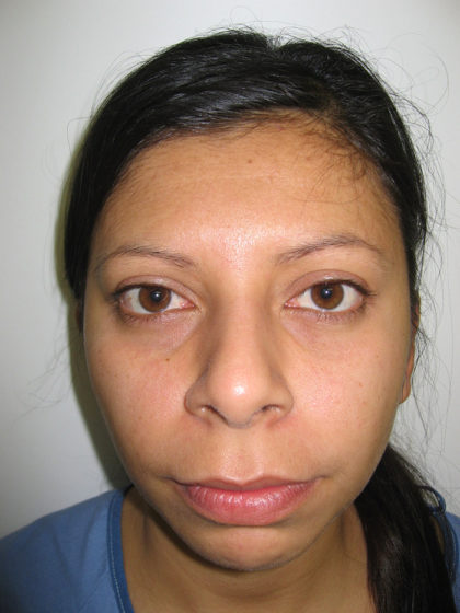 Chin Augmentation Before & After Patient #7860