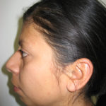 Chin Augmentation Before & After Patient #7860