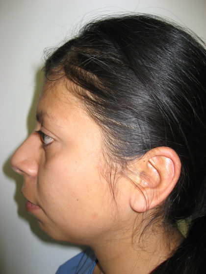 Chin Augmentation Before & After Patient #7860