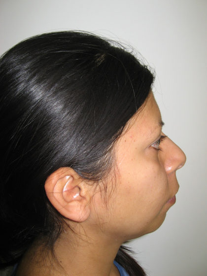 Chin Augmentation Before & After Patient #7860