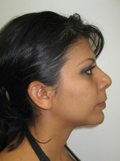 Chin Augmentation Before & After Patient #7860