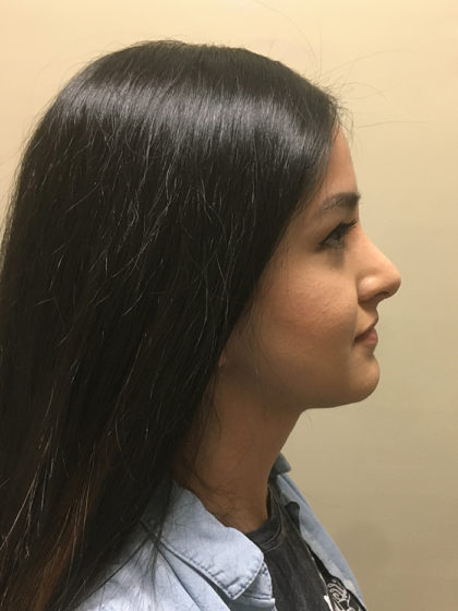 Chin Reduction Before & After Patient #7878