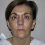 Facelift and Necklift Before & After Patient #7914