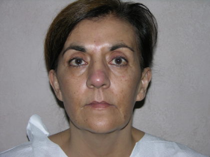 Facelift and Necklift Before & After Patient #7914