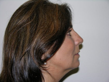 Facelift and Necklift Before & After Patient #7914