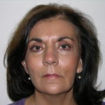 Facelift and Necklift Before & After Patient #7914