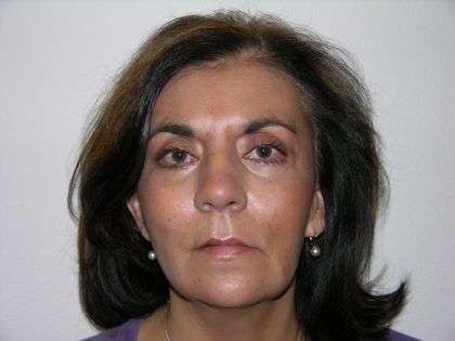 Facelift and Necklift Before & After Patient #7914