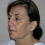 Facelift and Necklift Before & After Patient #7914