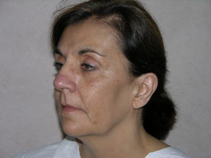 Facelift and Necklift Before & After Patient #7914