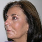 Facelift and Necklift Before & After Patient #7914