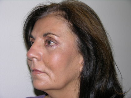 Facelift and Necklift Before & After Patient #7914