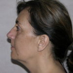 Facelift and Necklift Before & After Patient #7914