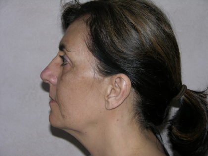 Facelift and Necklift Before & After Patient #7914