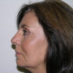 Facelift and Necklift Before & After Patient #7914