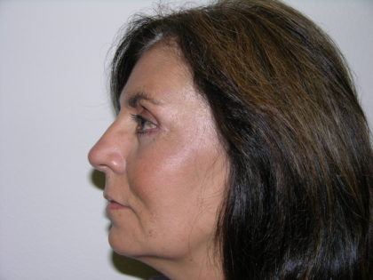 Facelift and Necklift Before & After Patient #7914