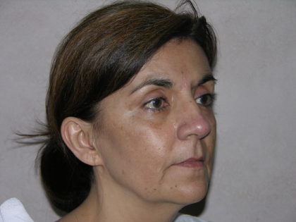 Facelift and Necklift Before & After Patient #7914