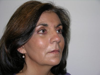 Facelift and Necklift Before & After Patient #7914