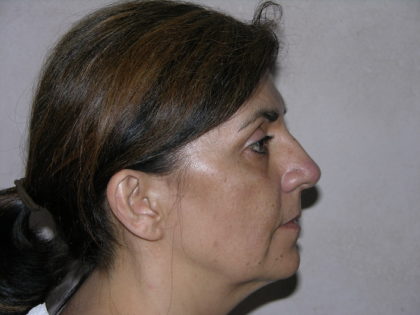 Facelift and Necklift Before & After Patient #7914